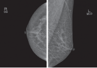 Foto Leasing BEMEMS Pinkview-DR PLUS Mammographiegerät - 3